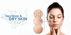 Hard Water effects on skin